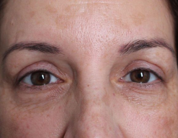 Mini necklift and upper blepharoplasty