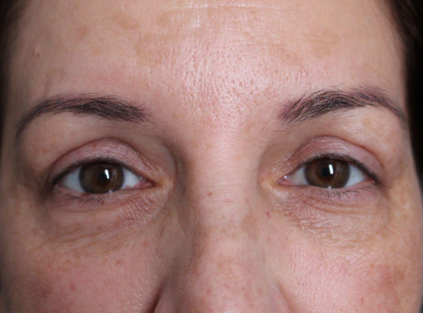 Mini necklift and upper blepharoplasty