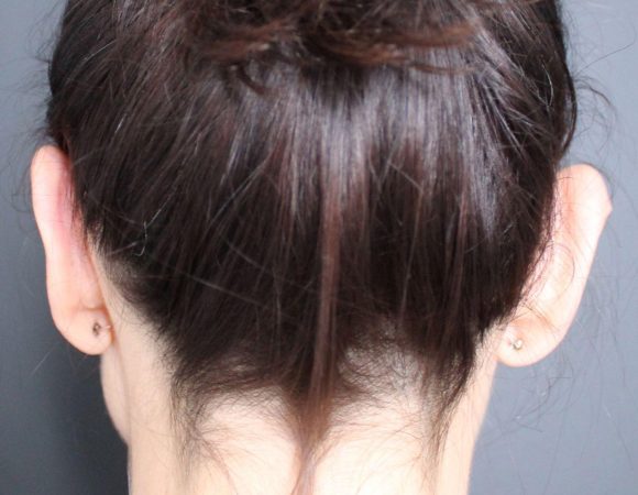 Post-op otoplasty