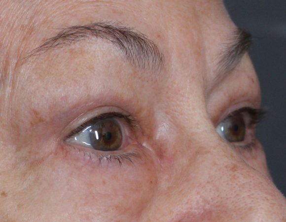 Post-op blepharoplasty (upper/lower) with fat transfer to face