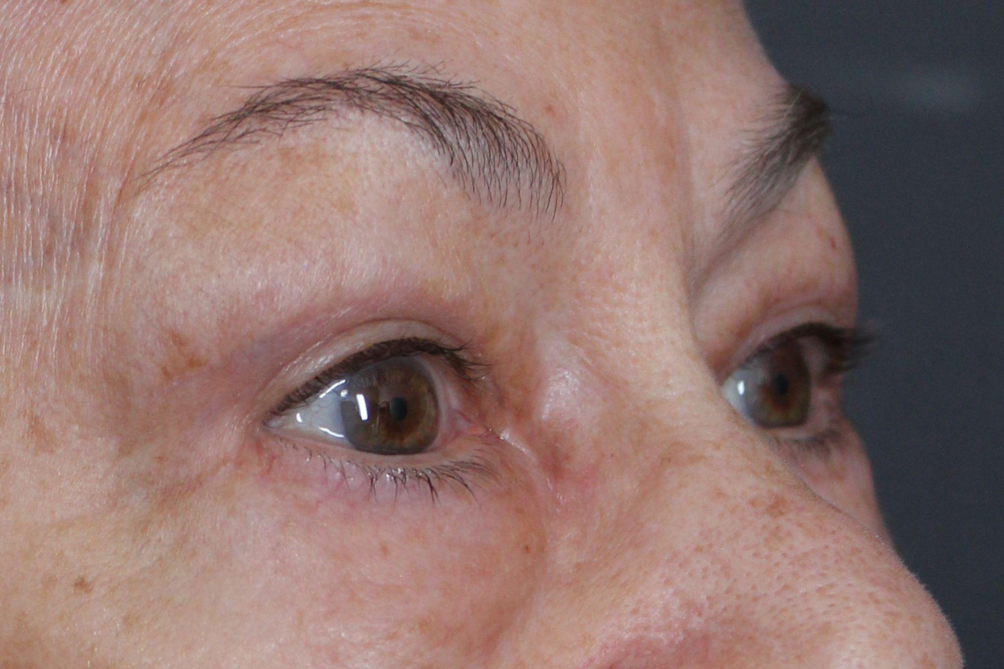 Post-op blepharoplasty (upper/lower) with fat transfer to face