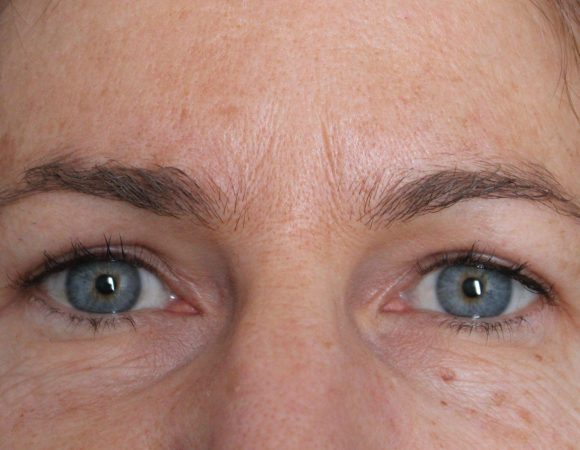 Post-op blepharoplasty