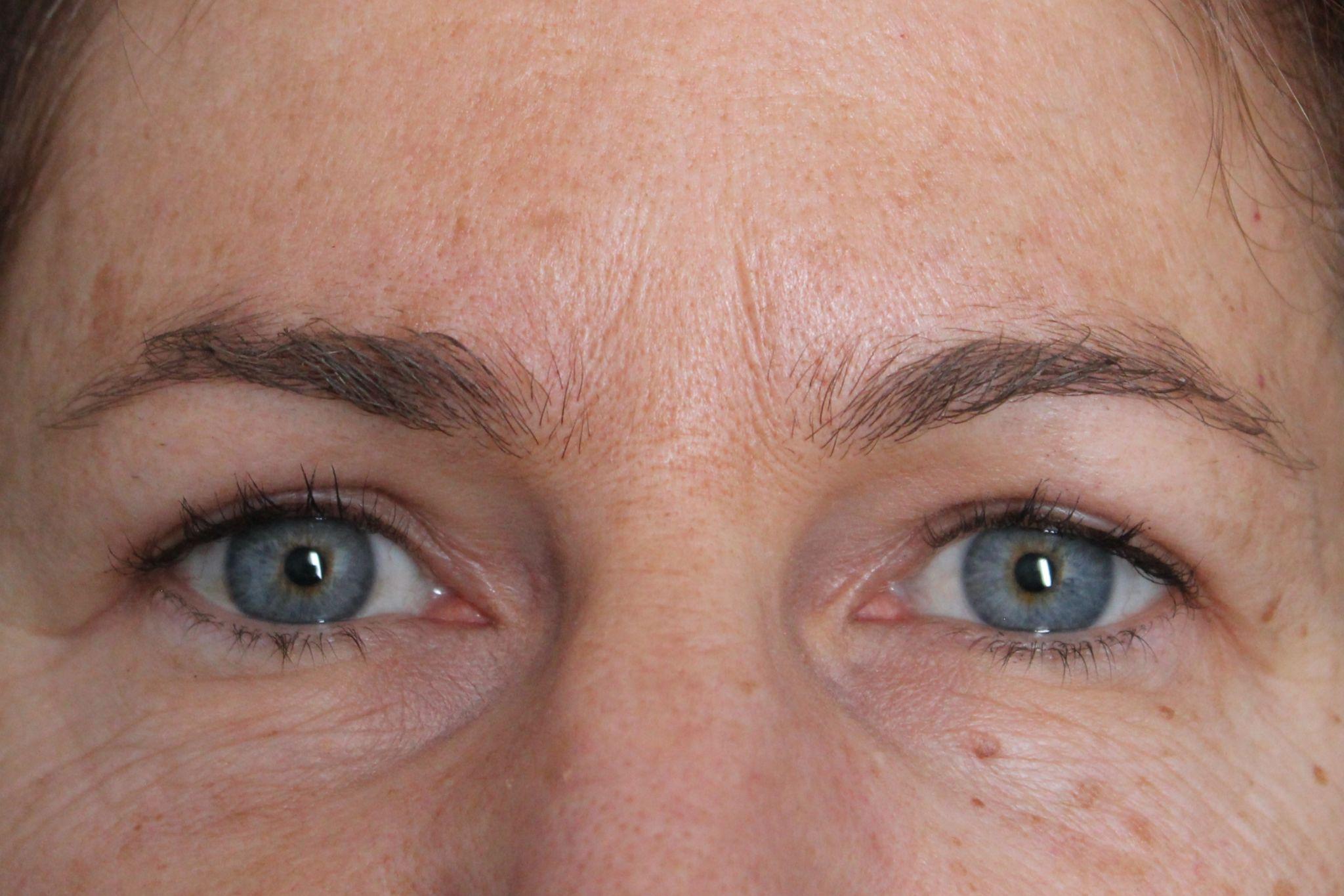 Post-op blepharoplasty