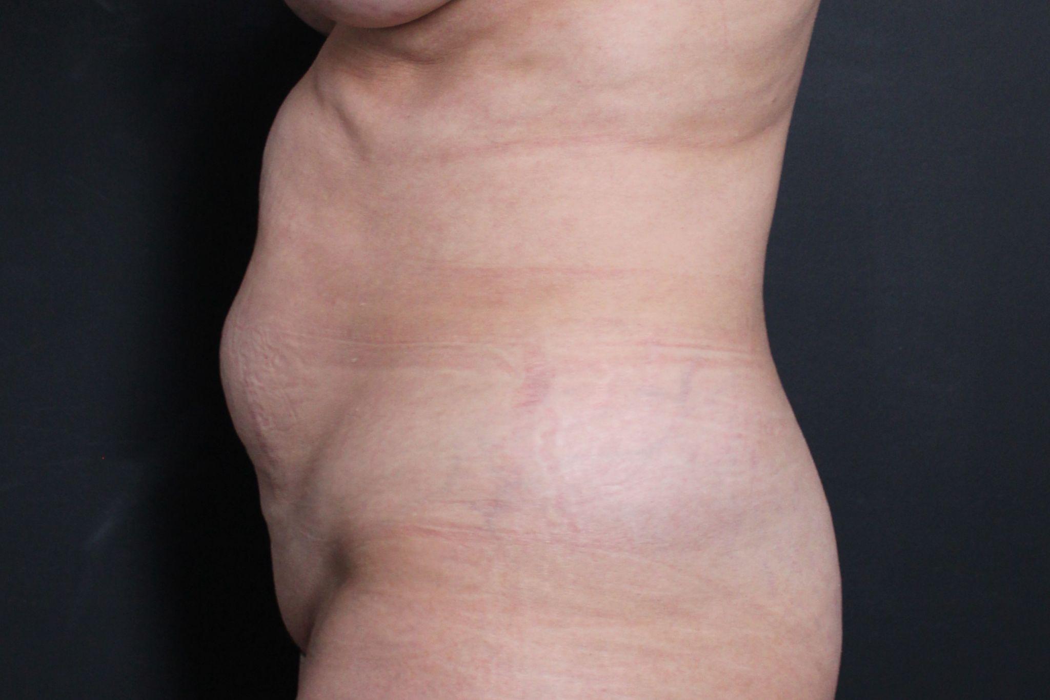 Pre-op abdominoplasty with lipsuction