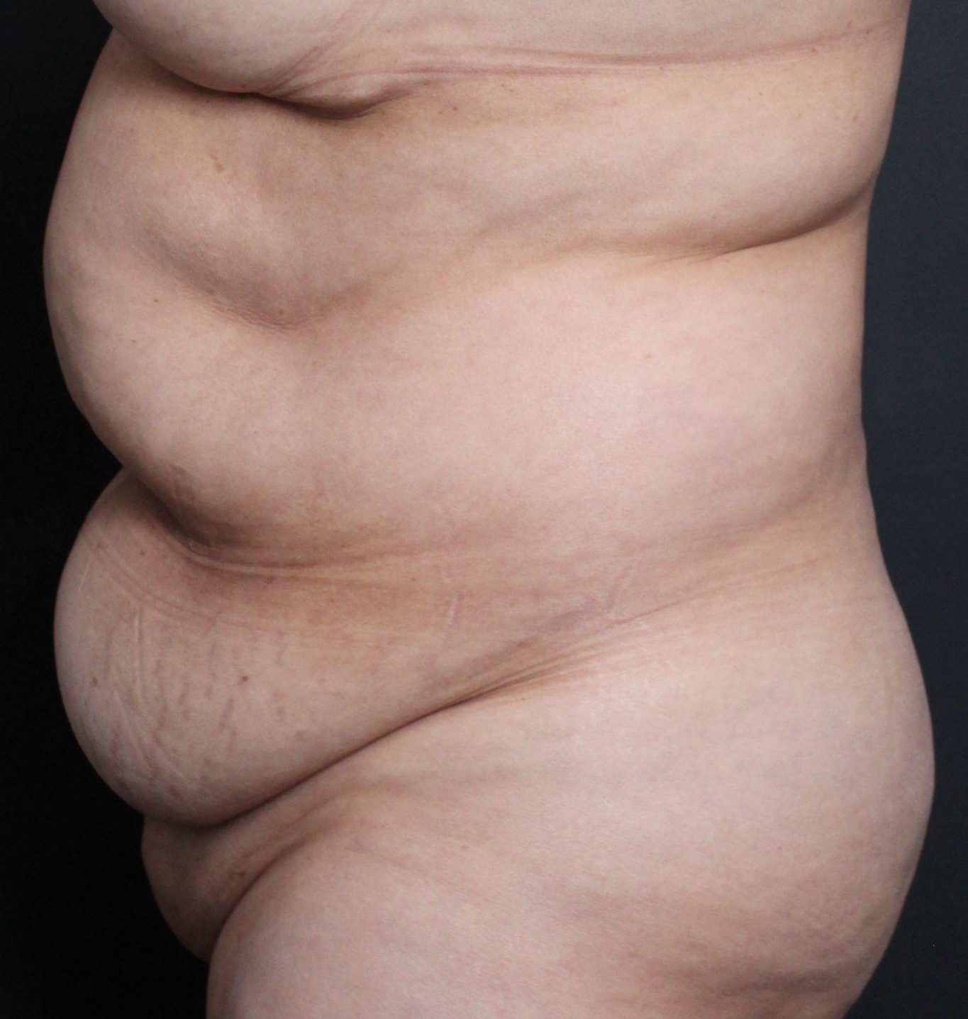 Pre-op abdominoplasty