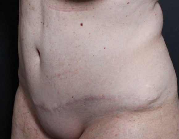 Post-op abdominoplasty