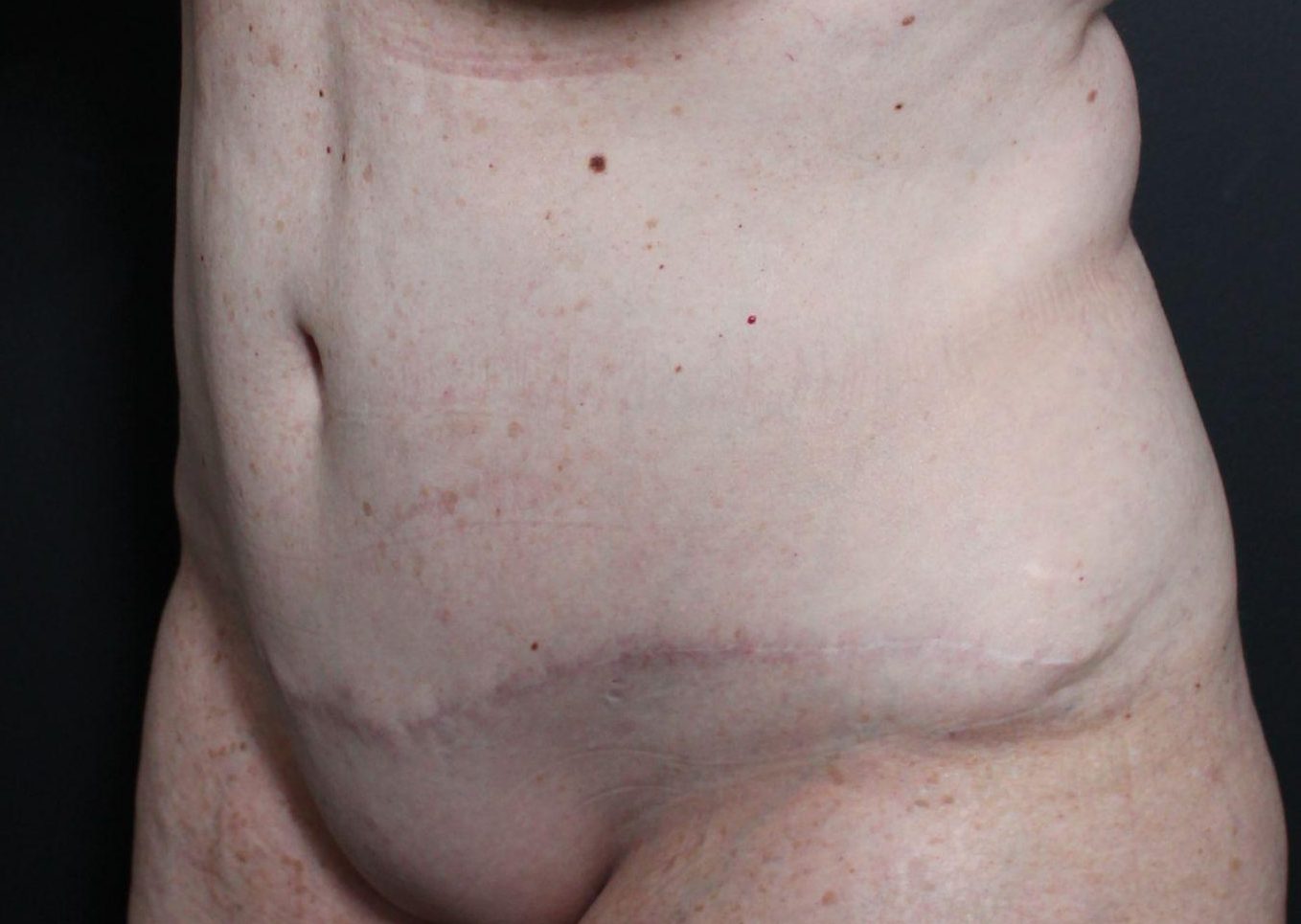 Post-op abdominoplasty