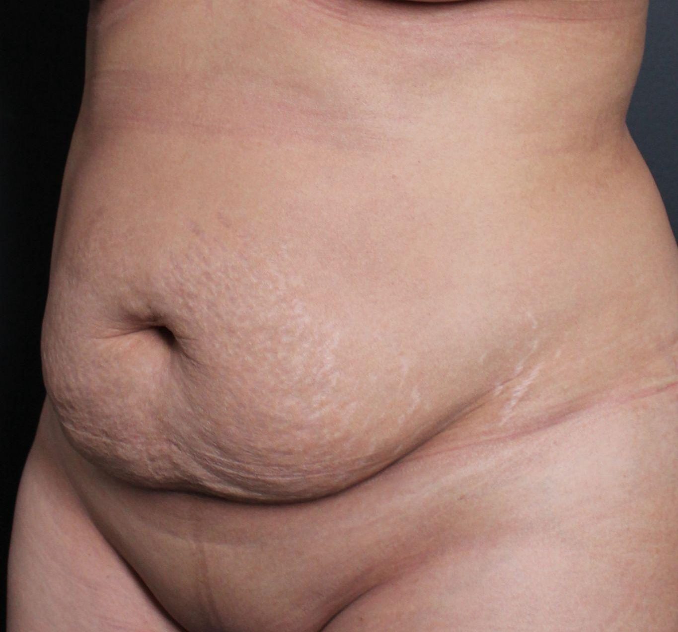 Before: <p>42 yrs | 5'2 | 150lbs | 1 year post-op</p>