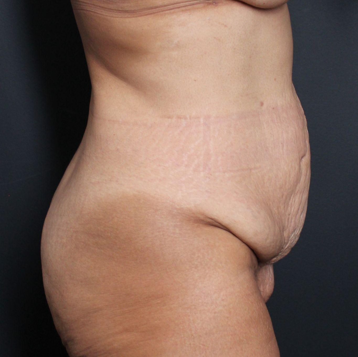 Before: <p>51 yrs | 5'4 | 158 lbs | 1 year post-op</p>