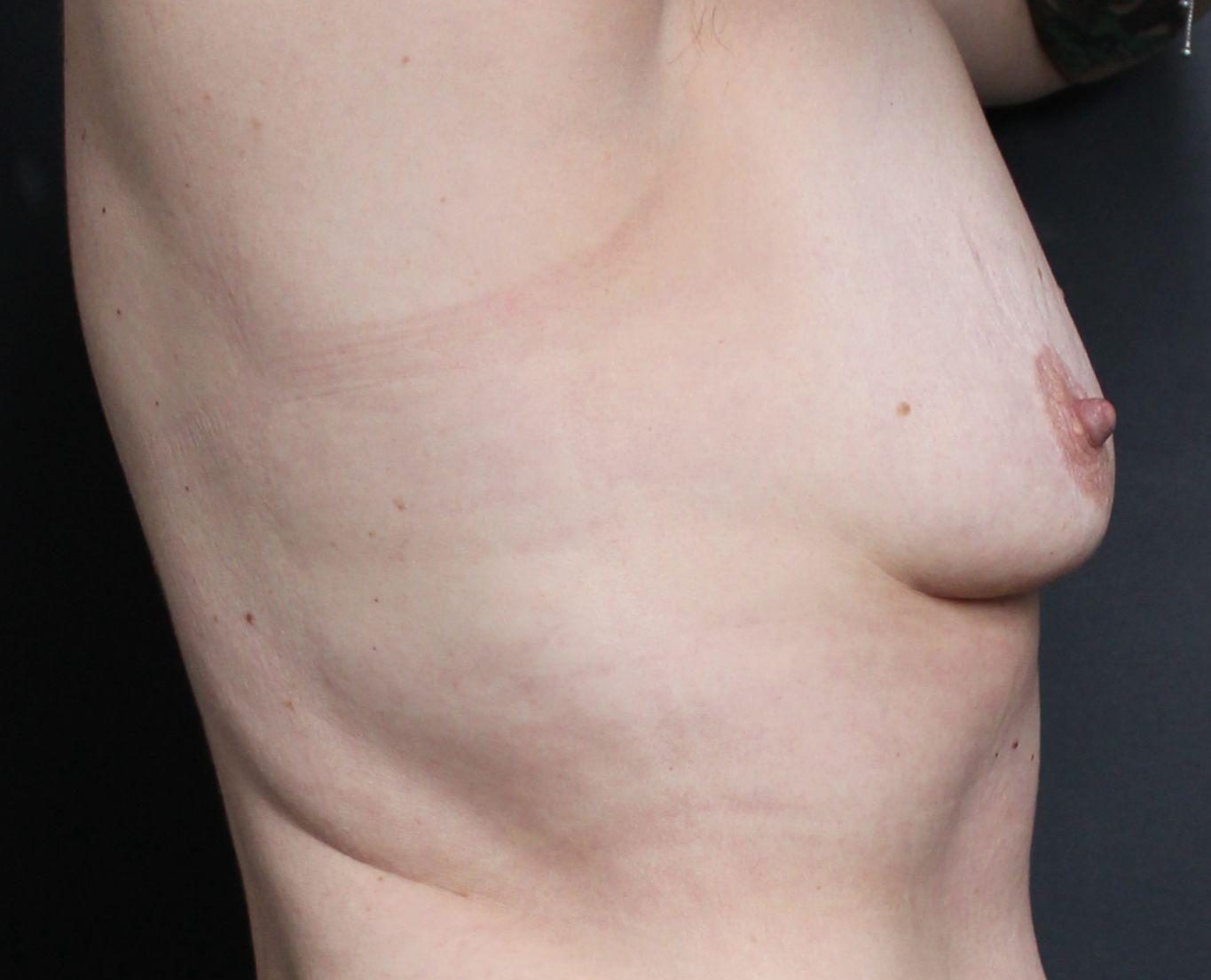 Before: <p>49 yrs | 156cm | 51kg | 345cc | Galatea mesh | 1 year post op</p>