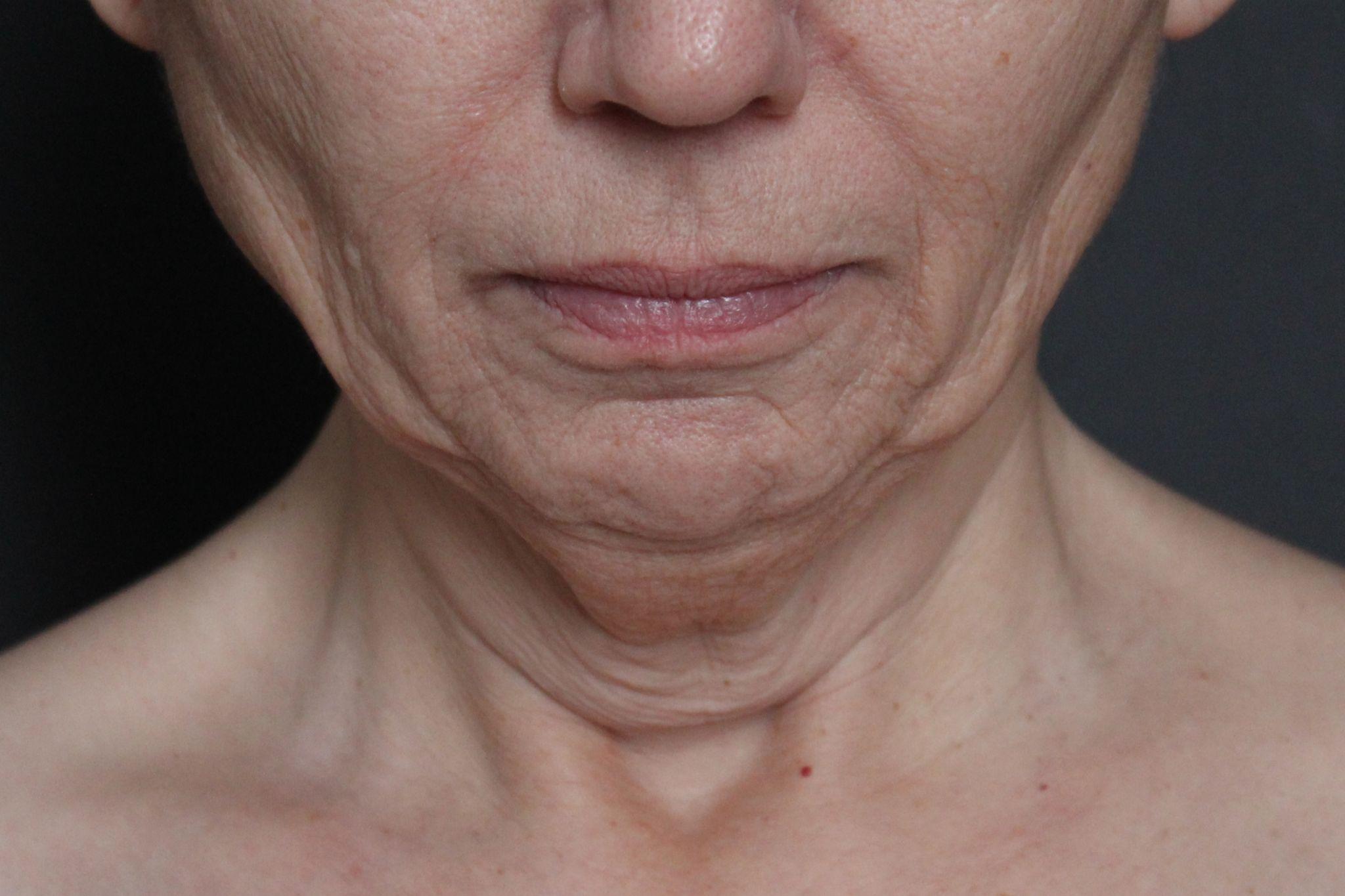 Before: <p>60 yrs | 5'4 | 145lbs | 6 months post-op</p><p>Facelift, Open Necklift, Radiofrequency Skin Tightening, Fat Transfer to Face, Blepharoplasty, Laser Resurfacing</p>