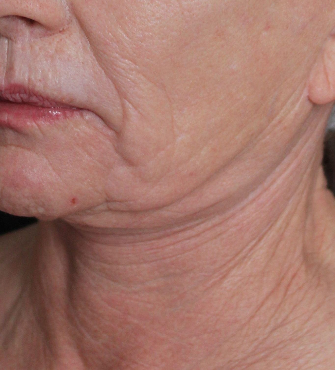 Before: <p>62 yrs | 5'3 | 133 | 6 weeks post-op</p><p>Facelift, Open Necklift, Radiofrequency Skin Tightening, Fat Transfer to Face, Blepharoplasty, Laser Resurfacing</p>