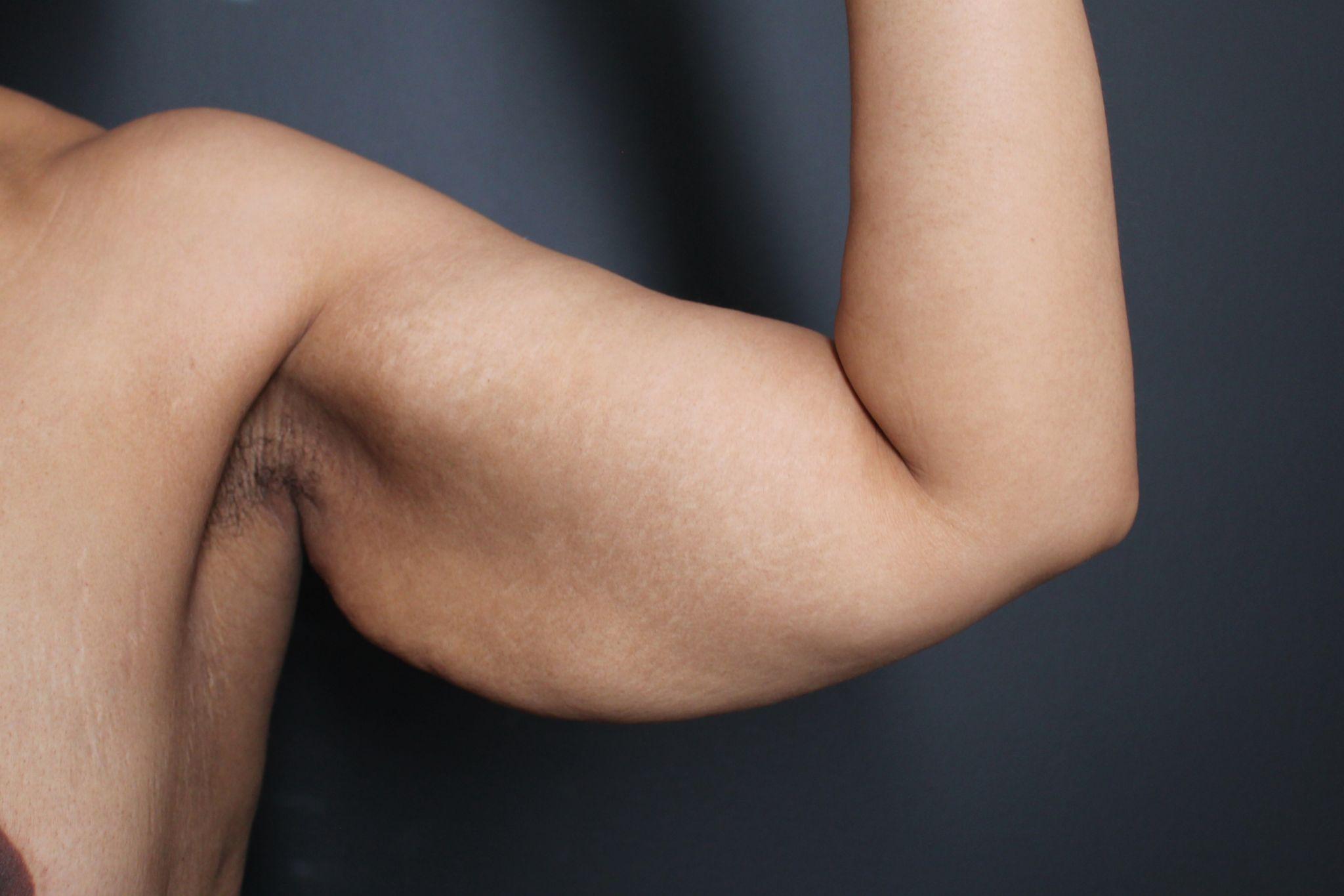 Before: <p>36 yrs | 5'7 | 176lbs | 6 months post-op</p><p>Brachioplasty with Vaser Liposuction and Radiofrequency Skin Tightening</p>