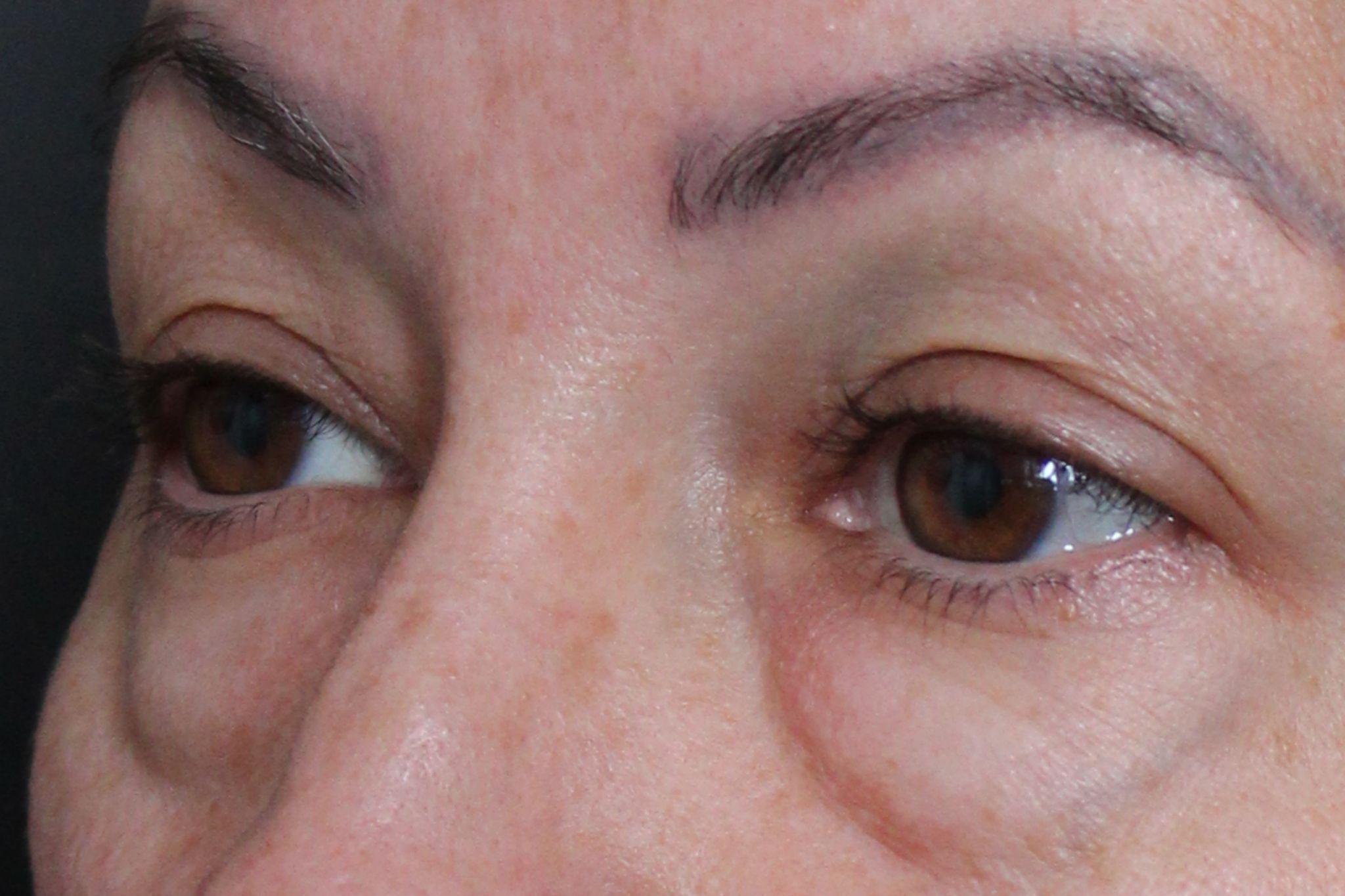 Before: <p>48 yrs | 5'3 | 117lbs | 6 weeks post-op</p><p>Fat Transfer to Teartroughs, Lower Lids, Medial and Lateral Cheek and Infra-Orbital Rim (with upper and lower blepharoplasty)</p>