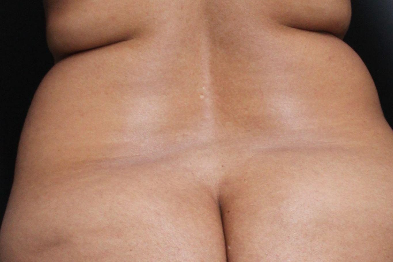 Before: <p>42 | 5'2 | 160lb | 1 year post-op</p><p>Radiofrequency Skin Tightening (with 360 Silhouette Vaser Liposuction with Fat Transfer)</p>