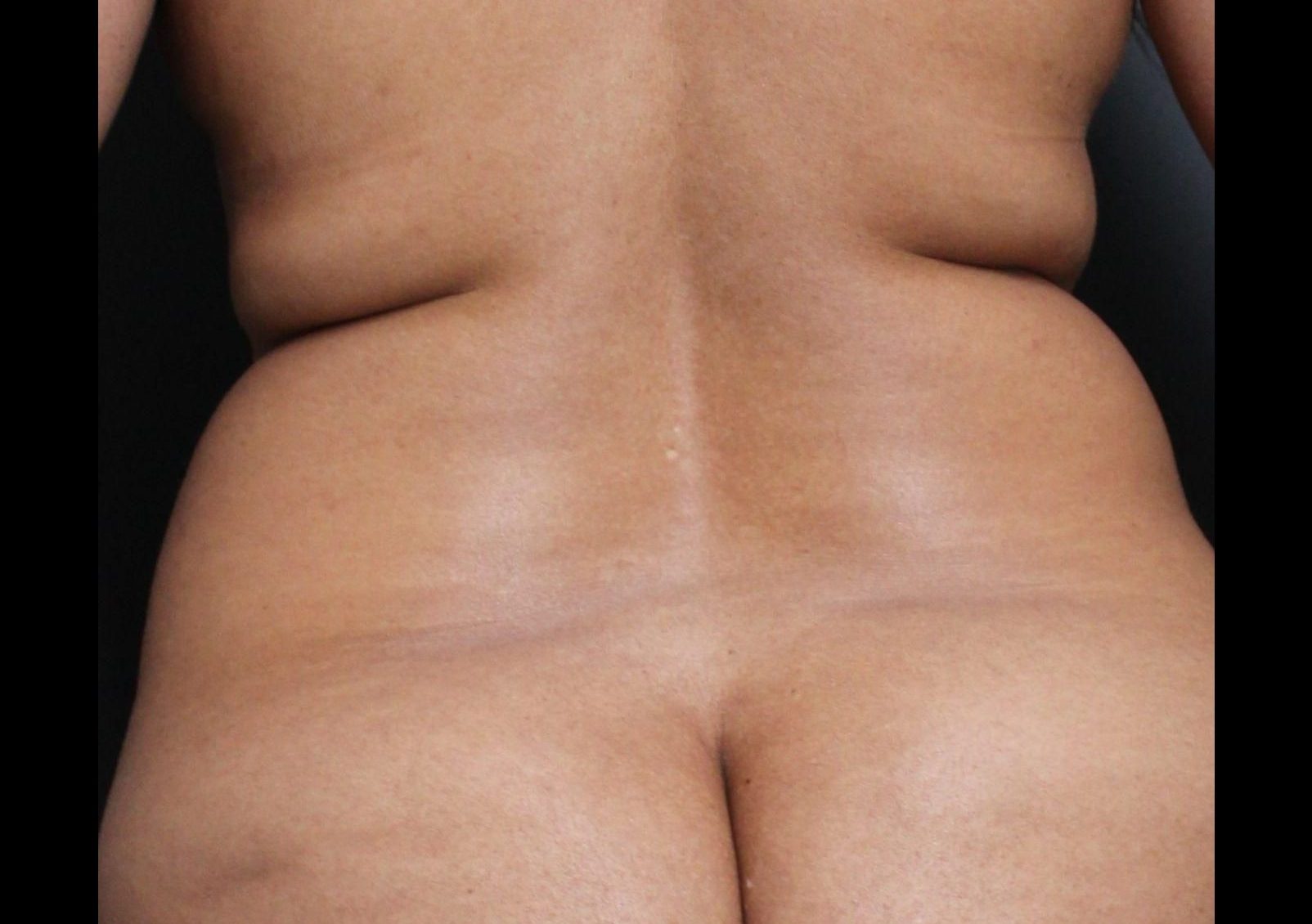 Before: <p>42 | 5'2 | 160lb | 6 months & 1 year post-op</p><p>Fat Transfer for Shaping (with Vaser Liposuction and Radiofrequency Skin Tightening)</p>