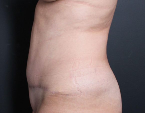 Post-op abdominoplasty with lipsuction