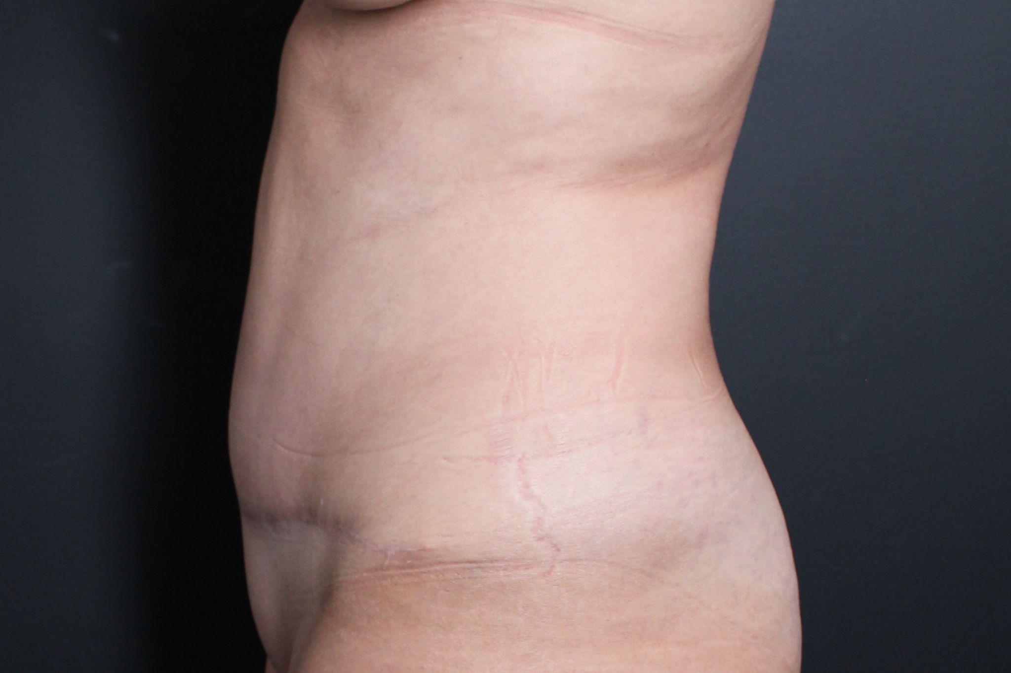 Post-op abdominoplasty with lipsuction