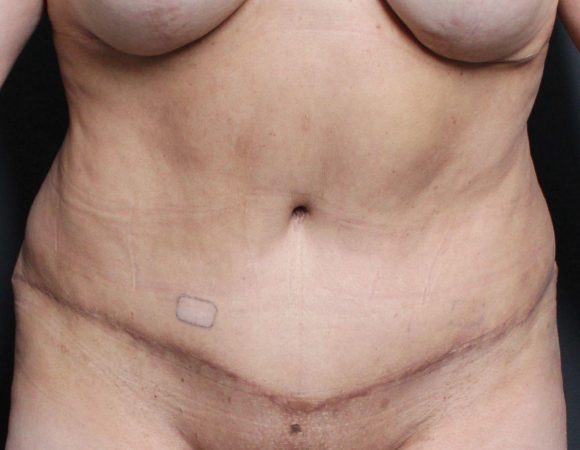 Post-op abdominoplasty