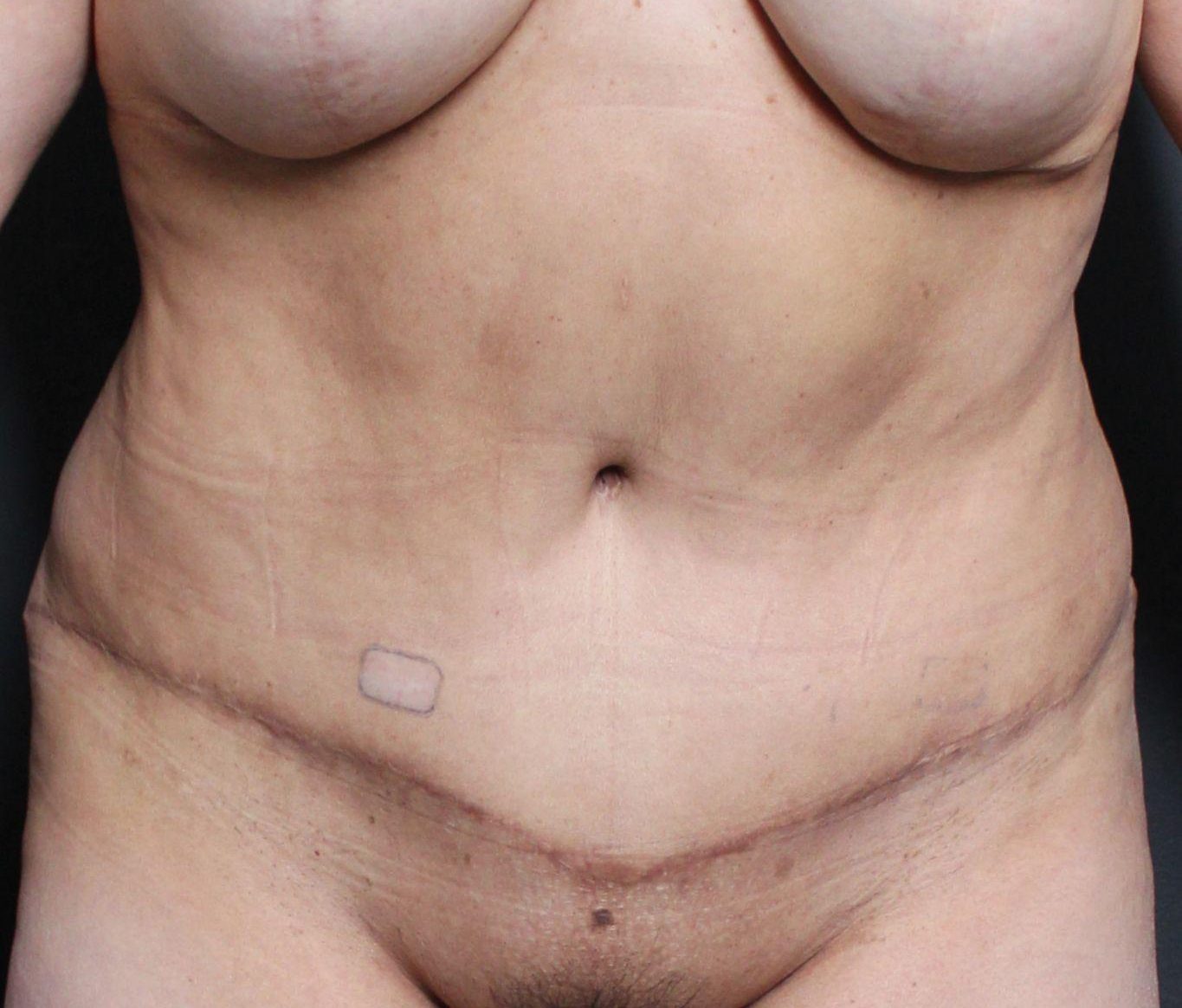 Post-op abdominoplasty