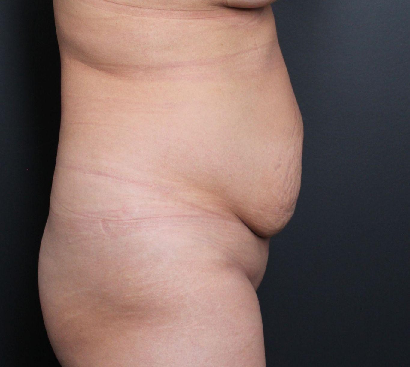 Before: <p>42 yrs | 5'2 | 150 lbs | 1 year post-op</p>