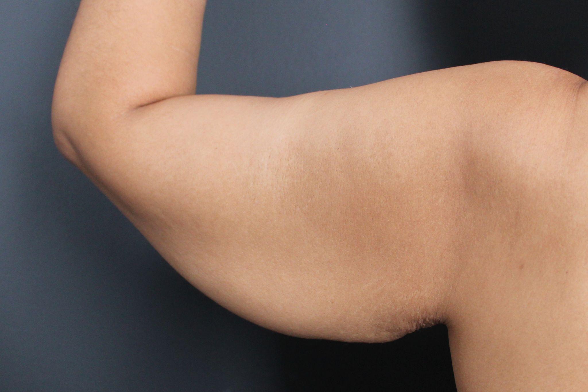 Before: <p>36 yrs | 5'7 | 176lbs | 6 months post-op</p><p>Brachioplasty with Vaser Liposuction and Radiofrequency Skin Tightening</p>