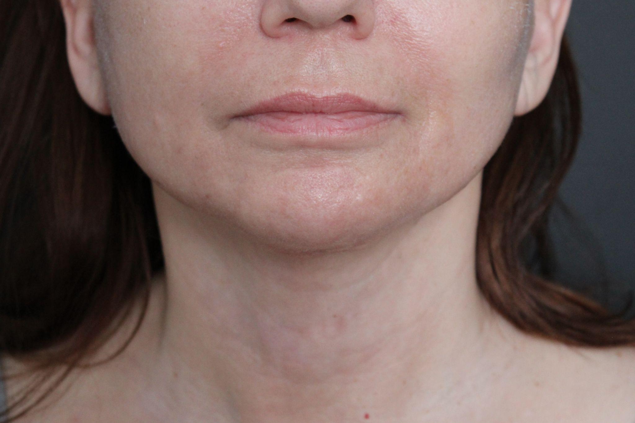 After: <p>60 yrs | 5'4 | 145lbs | 6 months post-op</p><p>Facelift, Open Necklift, Radiofrequency Skin Tightening, Fat Transfer to Face, Blepharoplasty, Laser Resurfacing</p>