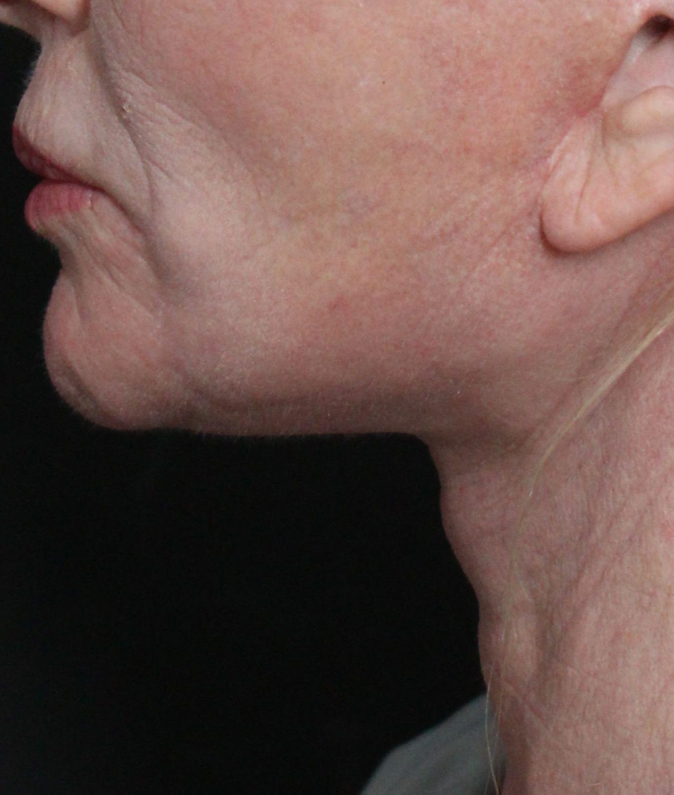 After: <p>62 yrs | 5'3 | 133 | 6 weeks post-op</p><p>Facelift, Open Necklift, Radiofrequency Skin Tightening, Fat Transfer to Face, Blepharoplasty, Laser Resurfacing</p>