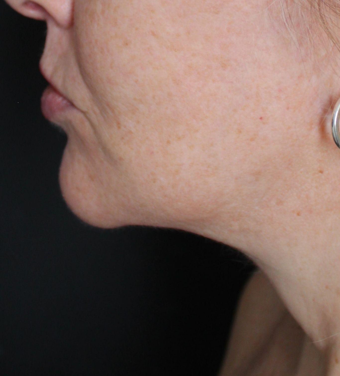 After: <p>55 yrs | 5'6 | 150lbs | 1 year post-op</p><p>Facelift, Open Necklift, Radiofrequency Skin Tightening, Belpharoplasty, Fat Transfer to Face</p>