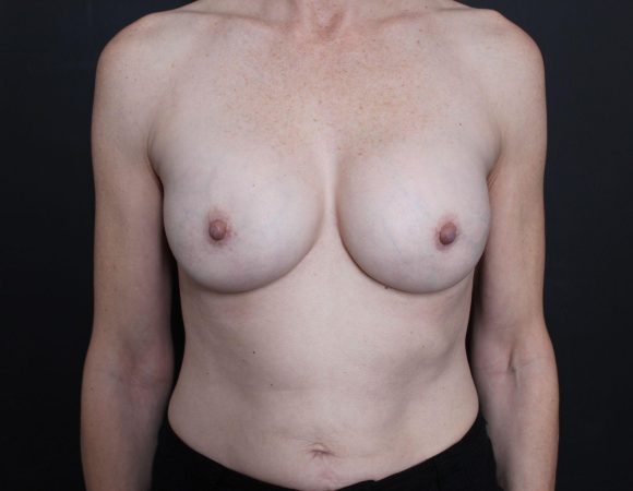 Post-op photo after breast augmentation