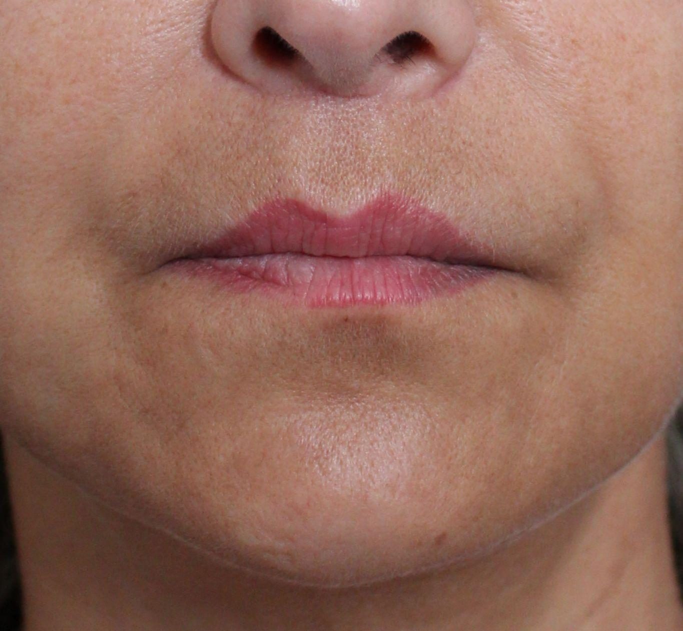 After: <p>56 yrs | 5'5 | 152lbs | 6 months post-op</p><p>Fat Transfer to Full Face (with Facelift, Open Necklift, Radiofrequency Skin Tightening and Lip Lift)</p>