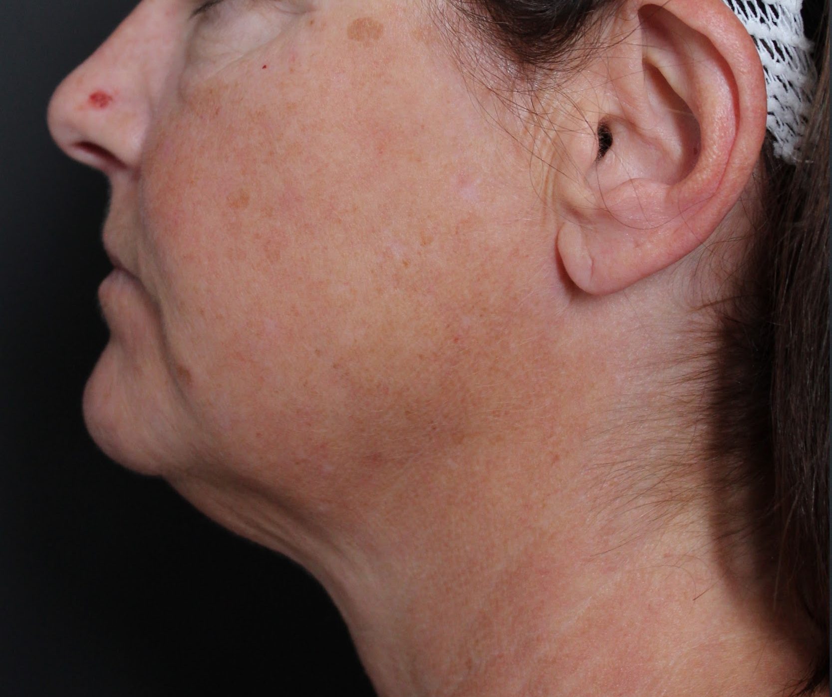 Before: <p>58 | 5'4 | 134 | 1 year 4 months post-op</p><p>Facelift, Open Necklift, Radiofrequency Skin Tightening, Fat Transfer to Face, Blepharoplasty</p>
