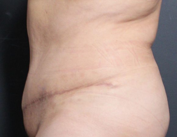 Post-op abdominoplasty