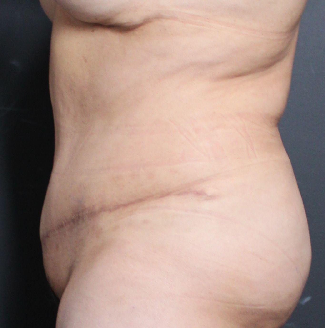 Post-op abdominoplasty