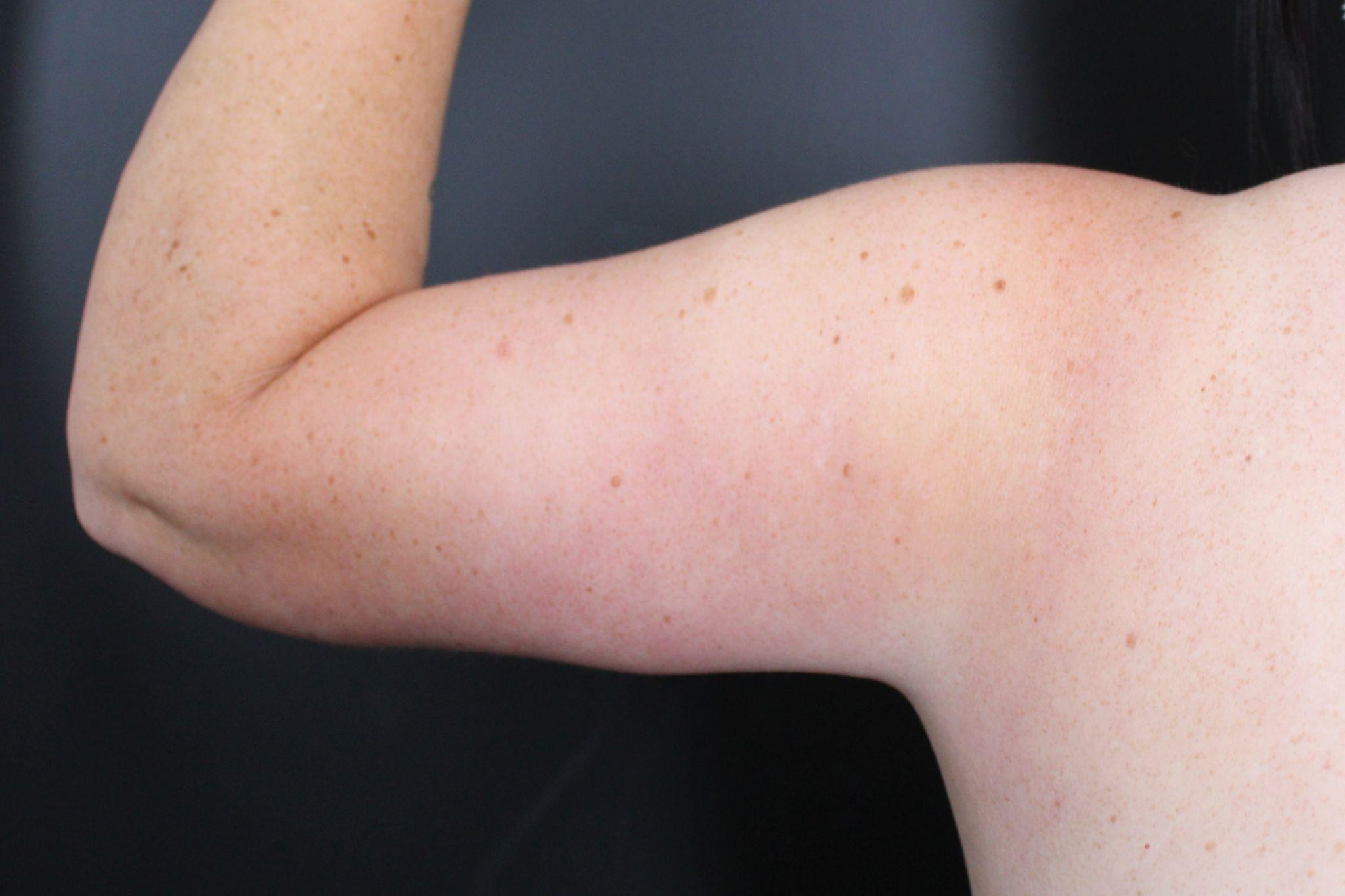 After: <p>44 yrs | 5'7 | 247lbs | 4 months post-op</p><p>Brachioplasty with Vaser Liposuction</p>