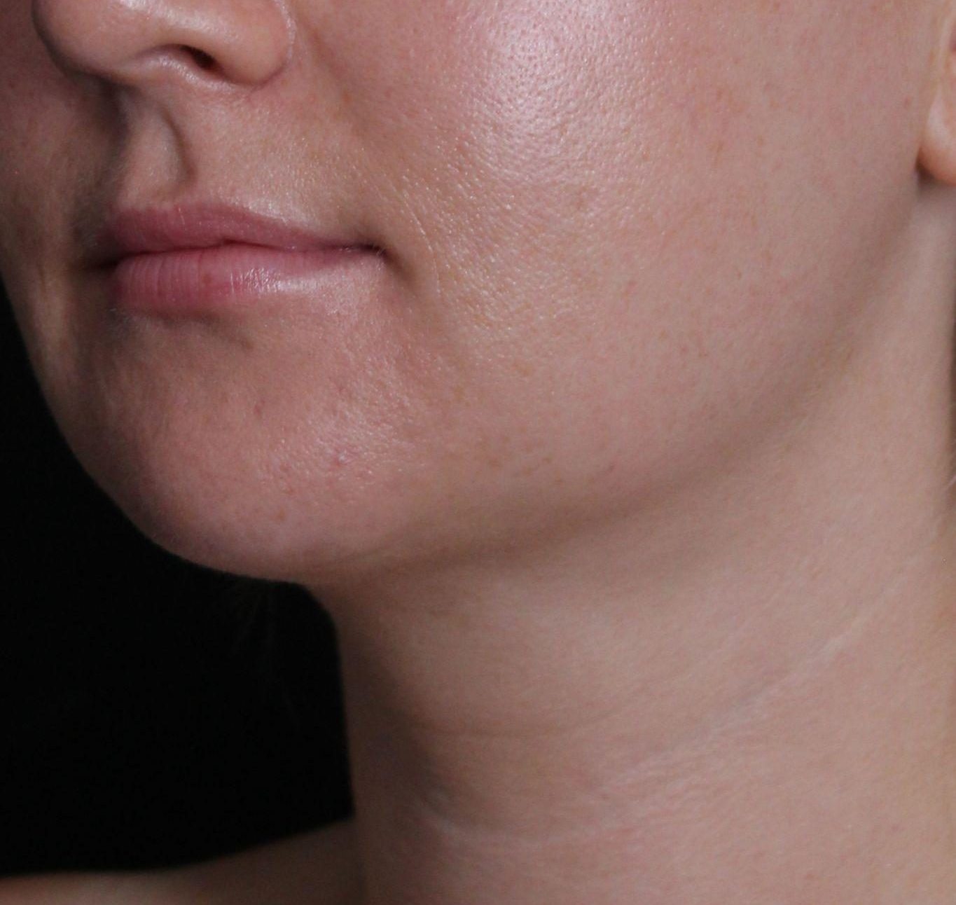 After: <p>27 yrs | 5'7 | 165 lbs | 3 months post-op</p><p>Radiofrequency Skin Tightening with Submental Liposuction</p>