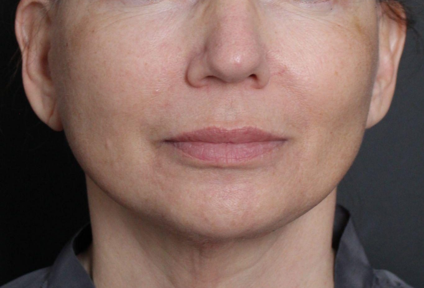 After: <p>60 yrs | 5'4 | 145lbs | 6 months post-op</p><p>Laser Resurfacing (+ Facial Rejuvenation Surgery)</p>