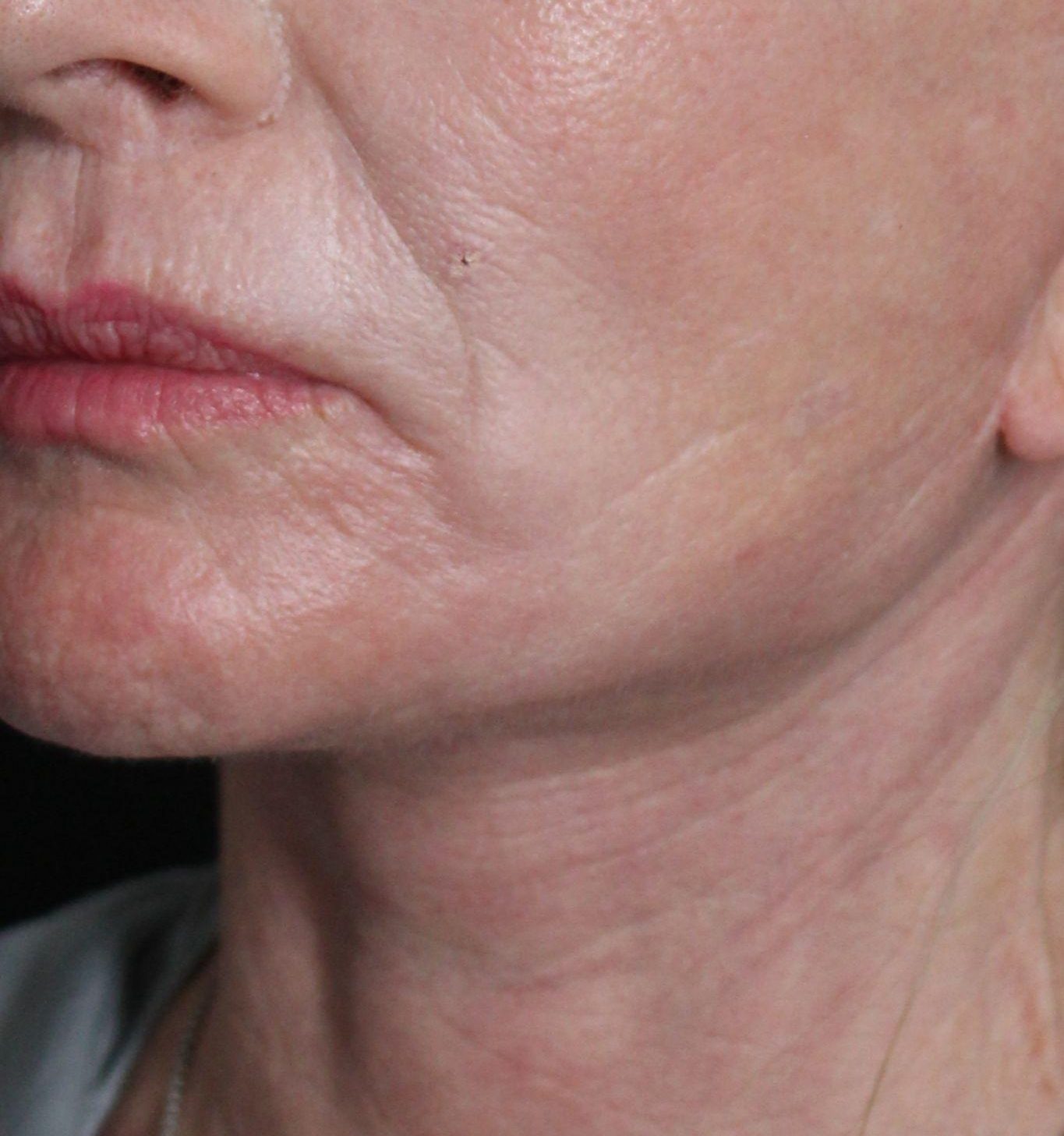 After: <p>62 yrs | 5'3 | 133 | 6 weeks post-op</p><p>Facelift, Open Necklift, Radiofrequency Skin Tightening, Fat Transfer to Face, Blepharoplasty, Laser Resurfacing</p>