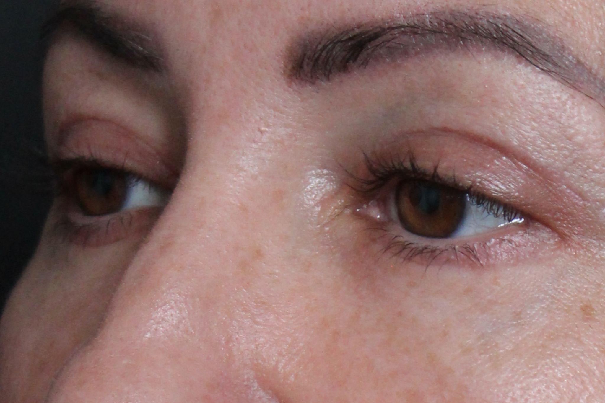 After: <p>48 yrs | 5'3 | 117lbs | 6 weeks post-op</p><p>Fat Transfer to Teartroughs, Lower Lids, Medial and Lateral Cheek and Infra-Orbital Rim (with upper and lower blepharoplasty)</p>