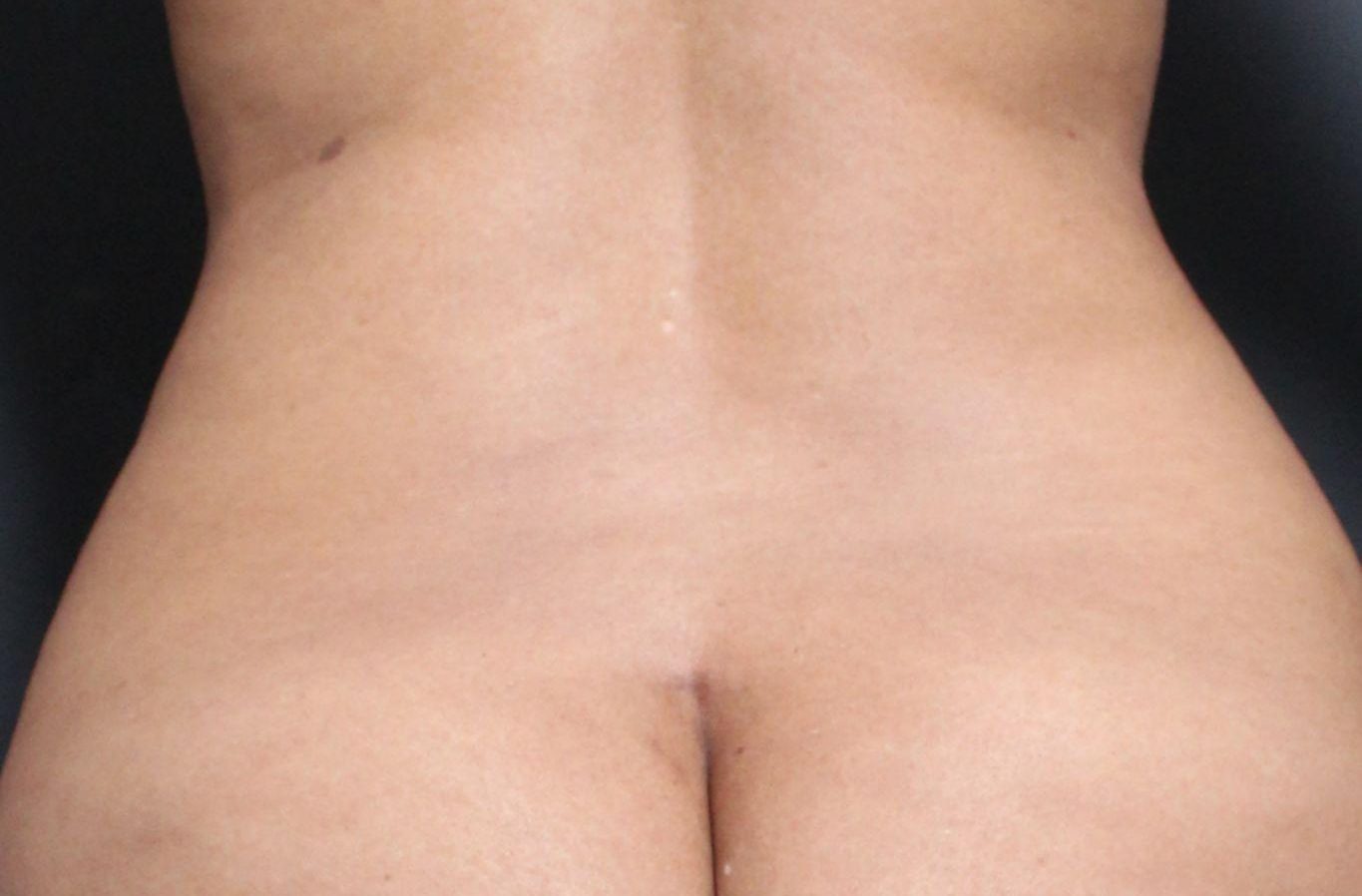 After: <p>42 | 5'2 | 160lb | 1 year post-op</p><p>Radiofrequency Skin Tightening (with 360 Silhouette Vaser Liposuction with Fat Transfer)</p>