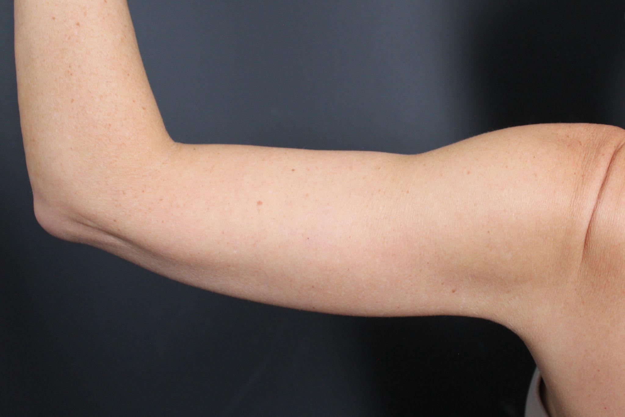 After: <p>46 | 5'6 | 134lbs | 7 months post-op</p><p>Radiofrequency Skin Tightening (with Brachioplasty)</p>