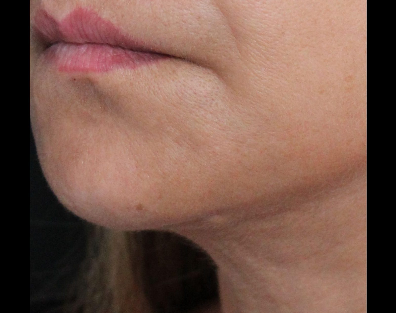 After: <p>56 yrs | 5'5 | 152lbs | 6 months post-op</p><p>Facelift, Open Necklift, Radiofrequency Skin Tightening, Lip Lift, Fat Transfer to Face, Blepharoplasty</p>