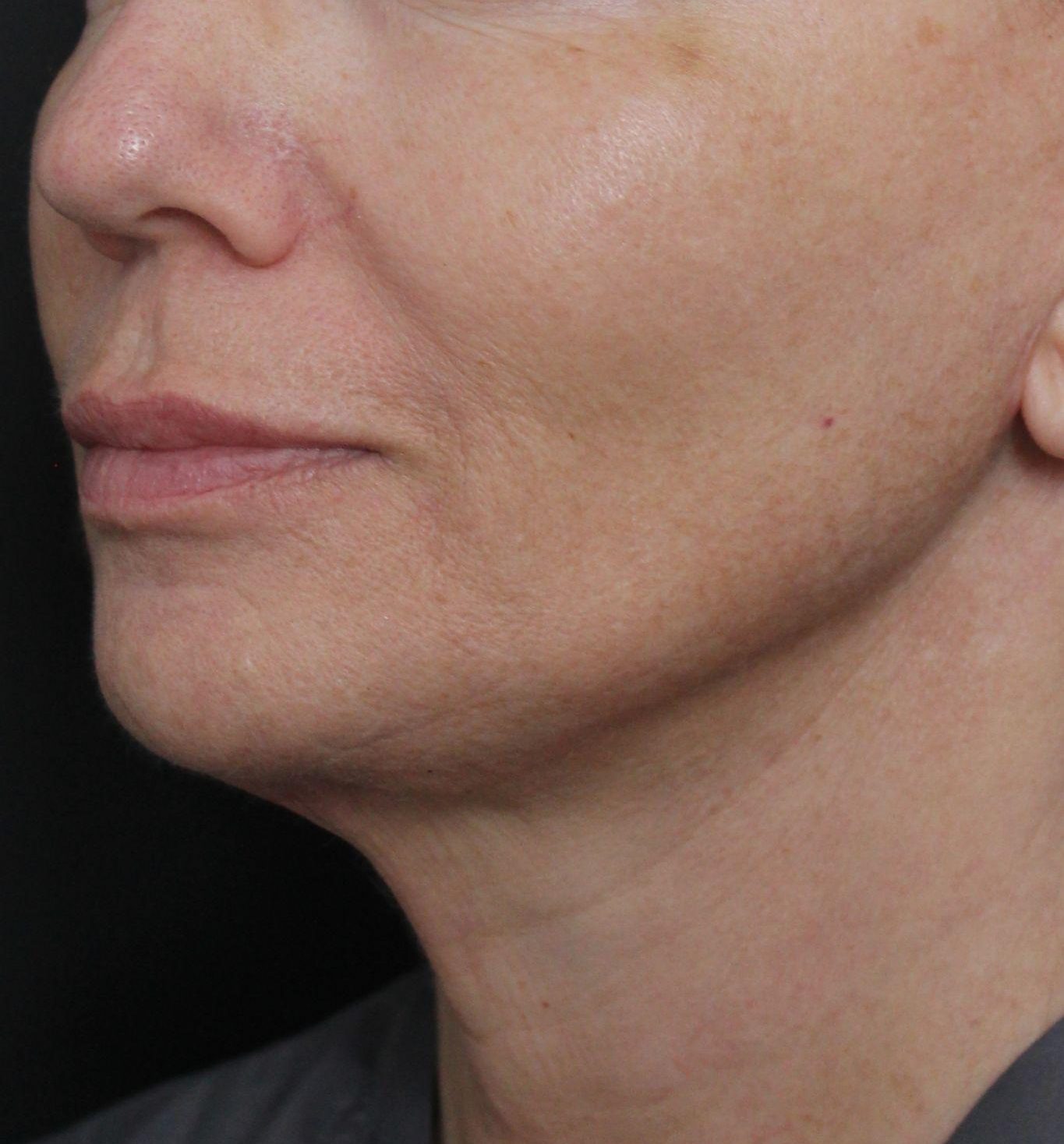 After: <p>60 yrs | 5'4 | 145lbs | 6 months post-op</p><p>Facelift, Open Necklift, Radiofrequency Skin Tightening, Fat Transfer to Face, Blepharoplasty, Laser Resurfacing</p>