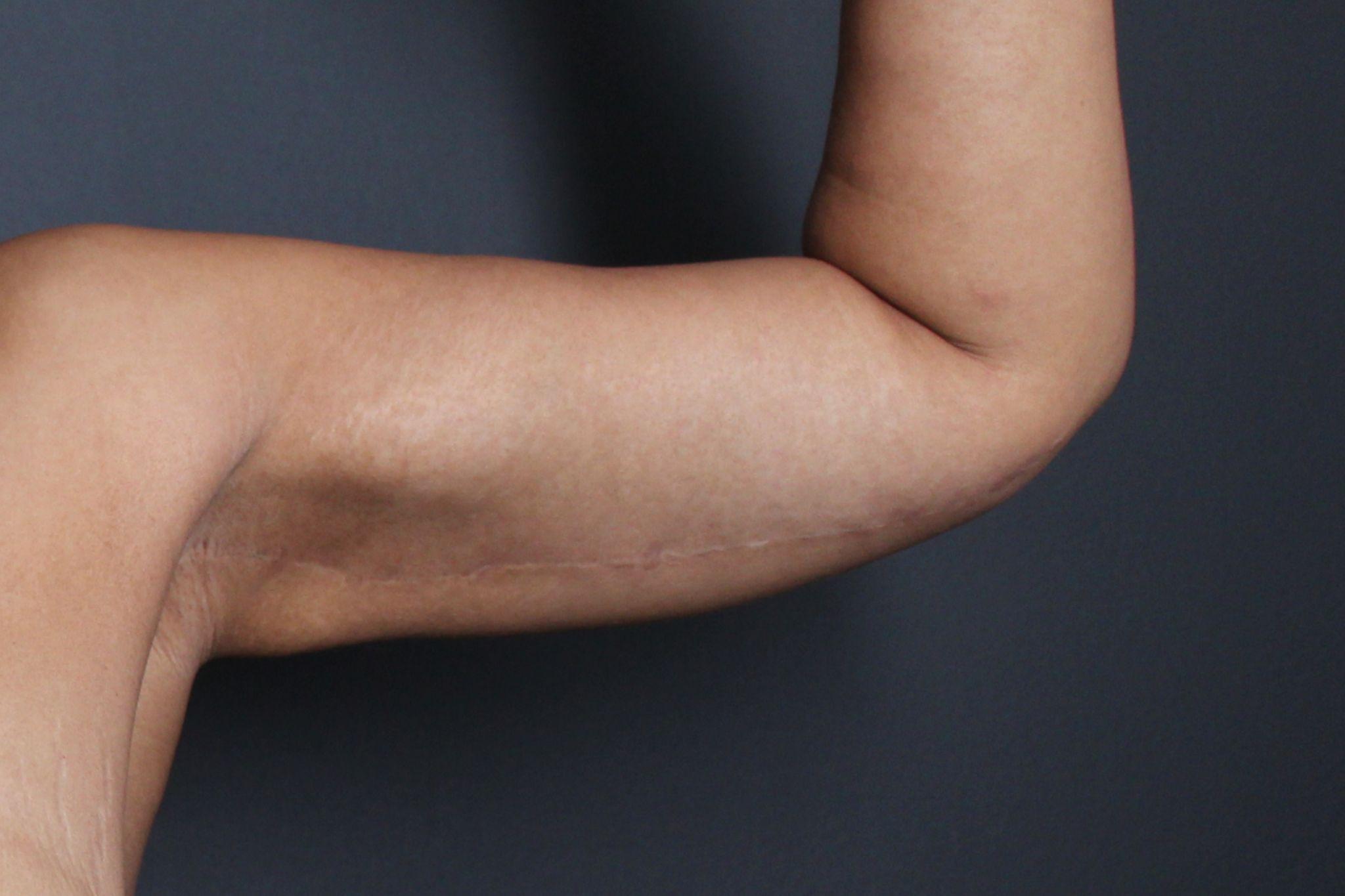 After: <p>36 yrs | 5'7 | 176lbs | 6 months post-op</p><p>Brachioplasty with Vaser Liposuction and Radiofrequency Skin Tightening</p>