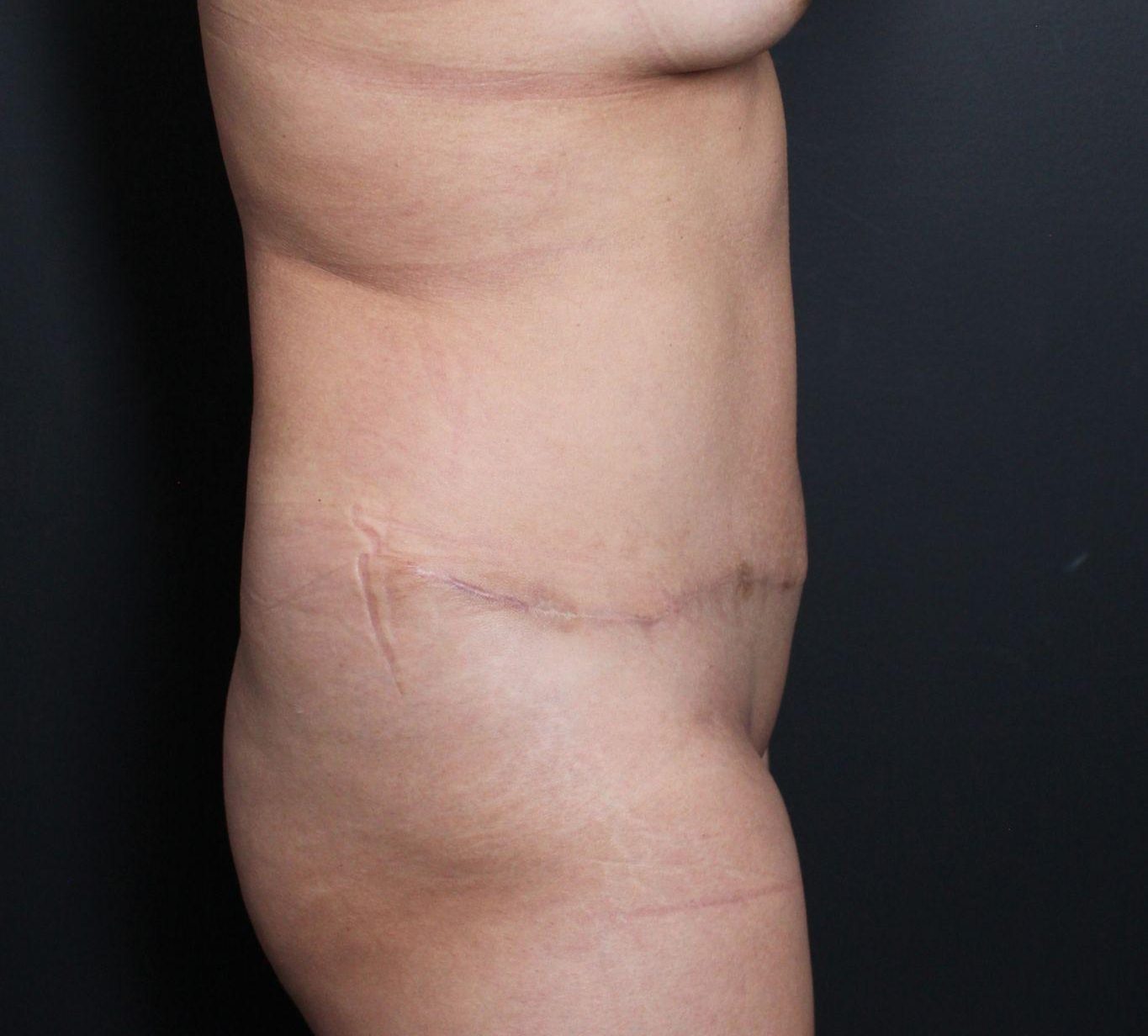 After: <p>42 yrs | 5'2 | 150 lbs | 1 year post-op</p>