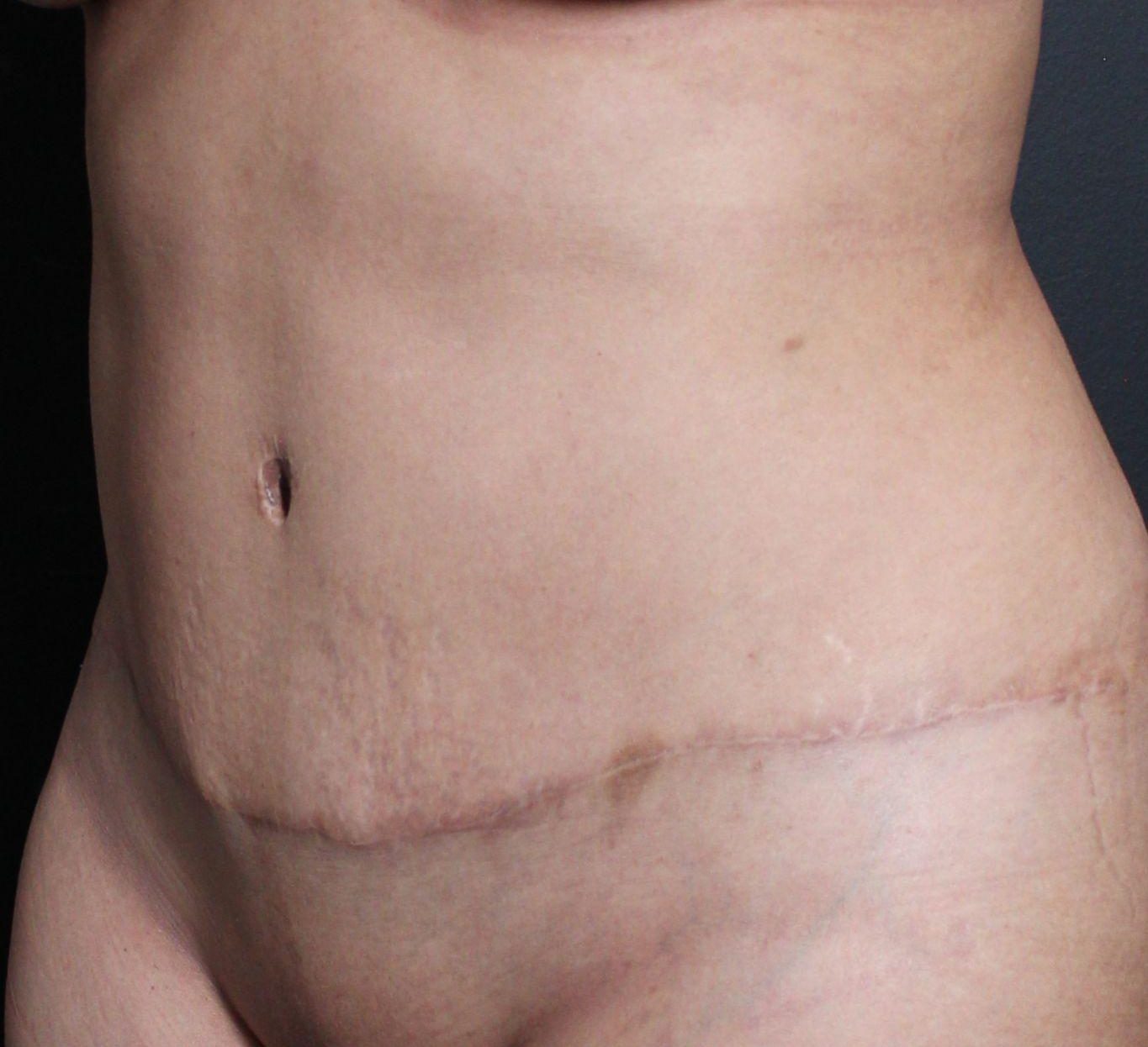 After: <p>42 yrs | 5'2 | 150lbs | 1 year post-op</p>