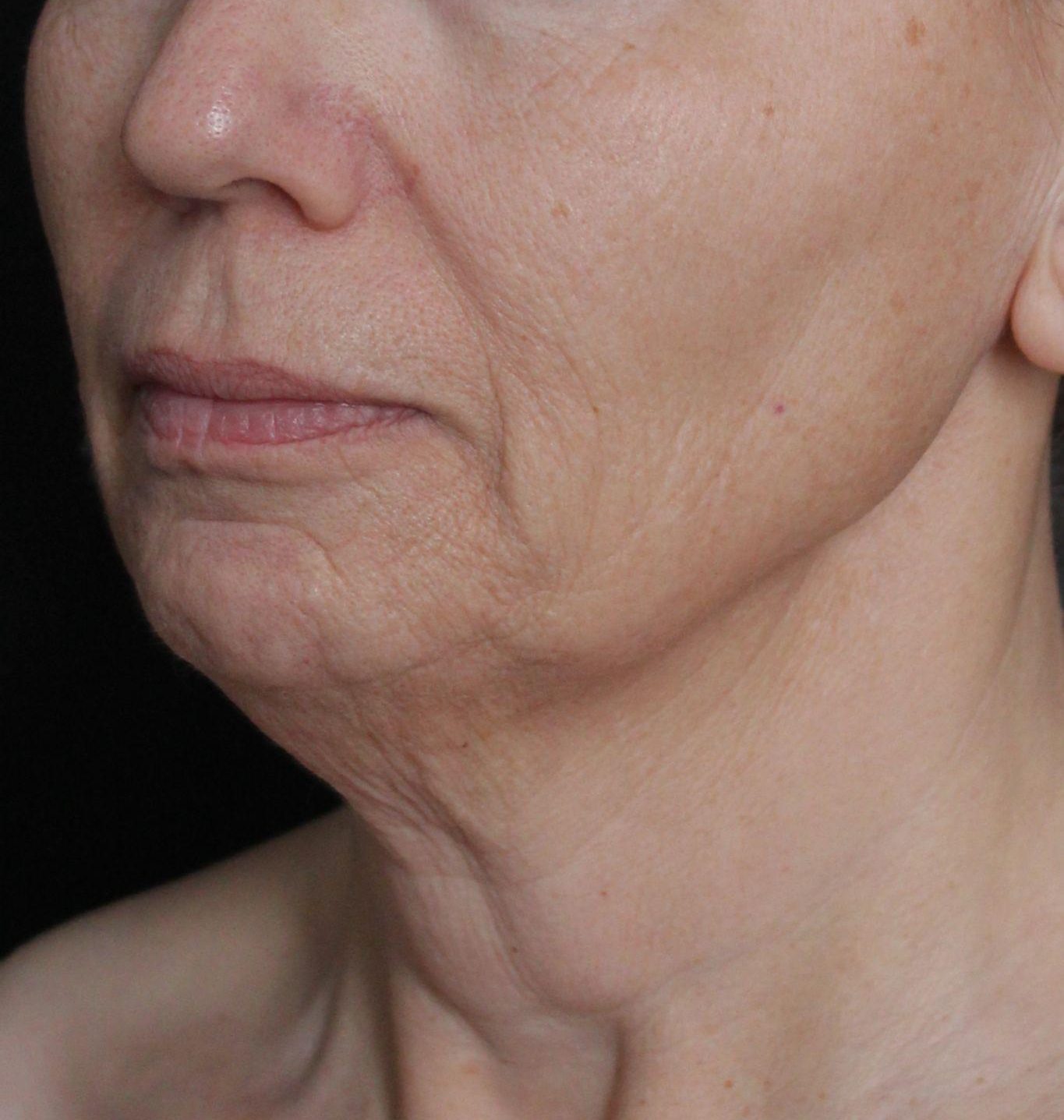 Before: <p>60 yrs | 5'4 | 145lbs | 6 months post-op</p><p>Facelift, Open Necklift, Radiofrequency Skin Tightening, Fat Transfer to Face, Blepharoplasty, Laser Resurfacing</p>