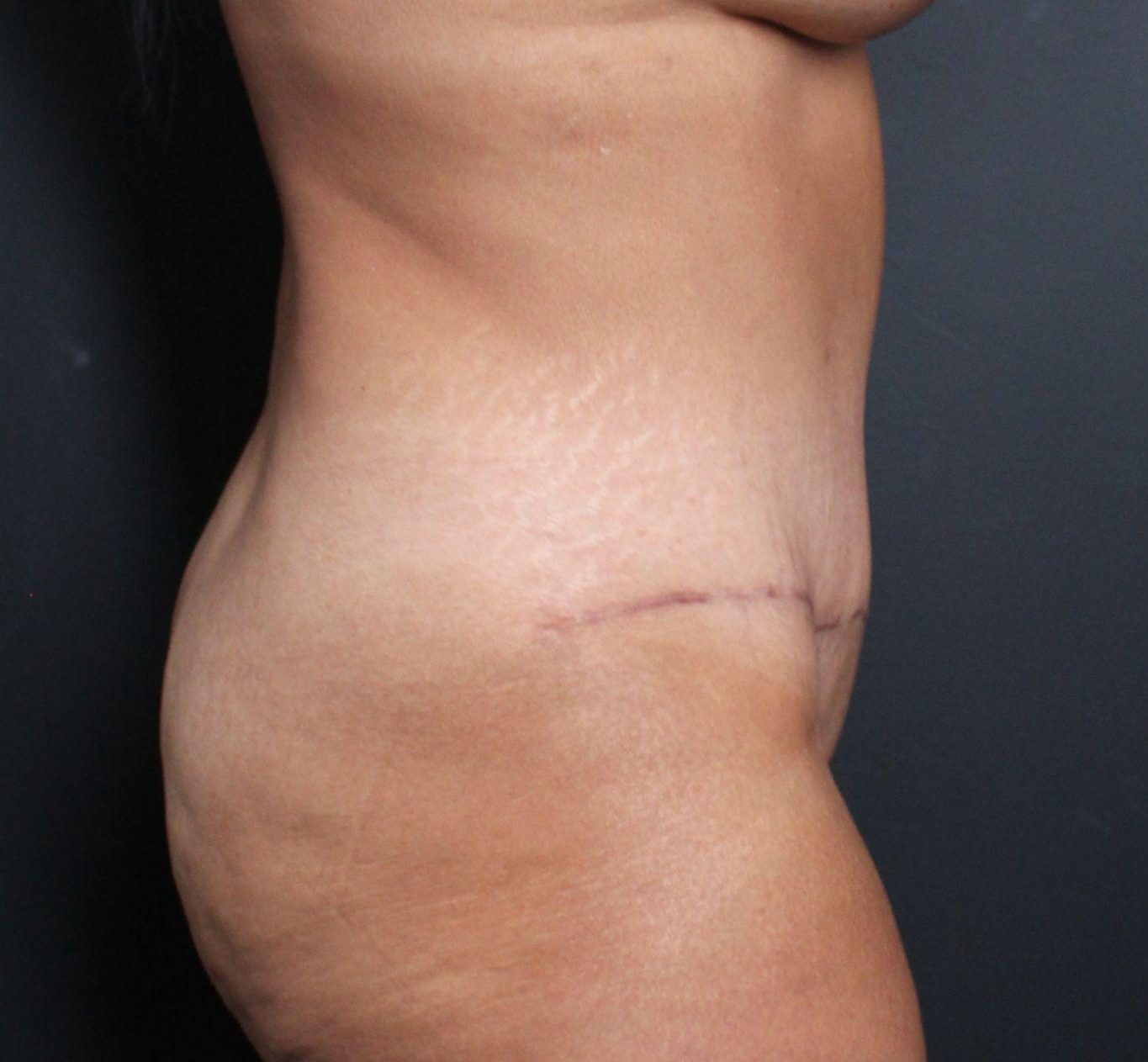 After: <p>51 yrs | 5'4 | 158 lbs | 1 year post-op</p>