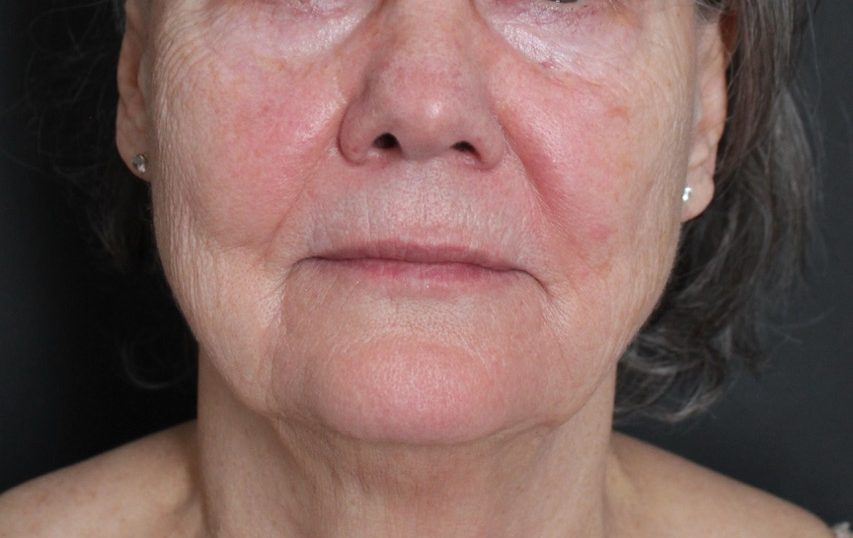 Before: <p>71 yrs | 5'7 | 160 lbs | 1 year post-op</p><p>Erbium Laser Resurfacing (+ Fat Transfer to Face)</p>
